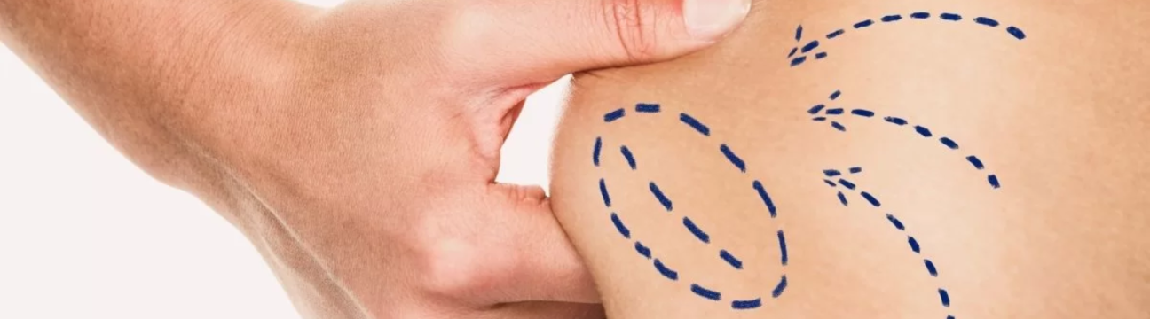 LiposuctionSurgery