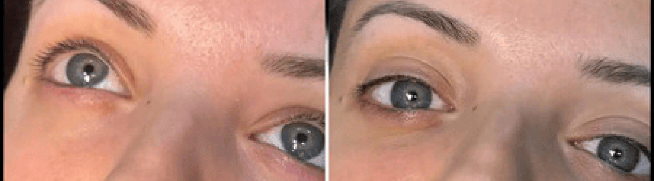dermalfillers